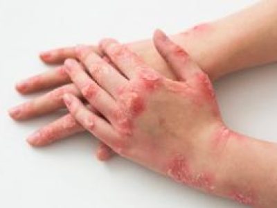 Kasus Cacar Monyet di Indonesia Semakin Meningkat, Ini Hal yang Perlu diwaspadai?