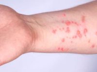 Kasus Cacar Monyet Meningkat, DPR: Gencarkan Vaksinasi